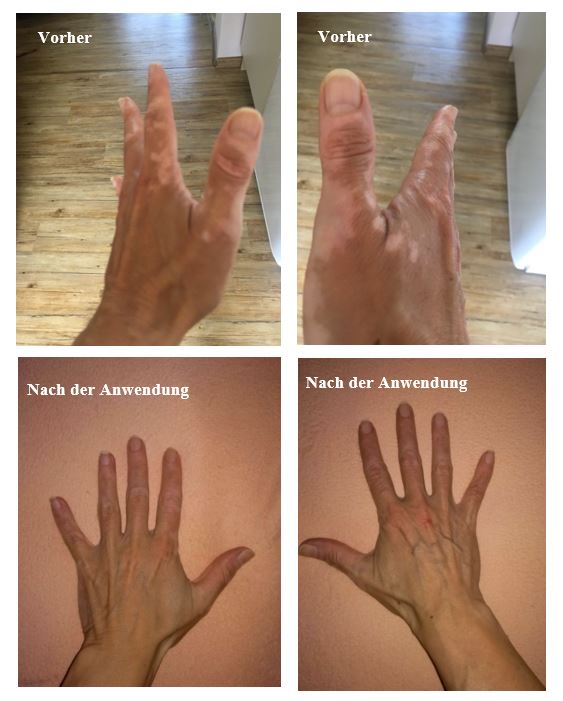 Repigmentierung der Hände