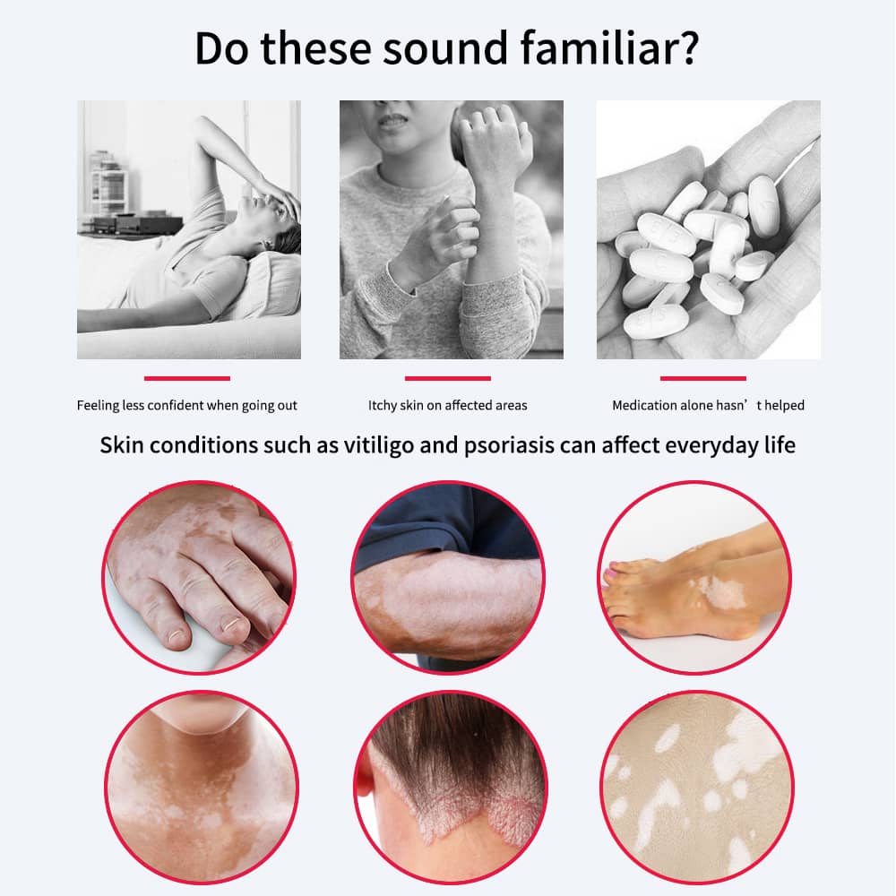 indications uvb lamp