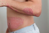 phototherapie Psoriasis