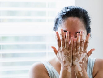 https://www.vitiligoshop.at/vitiligo/blog/faktoren-die-die-behandlung-von-vitiligo-beeinflussen