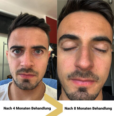 Vitiligo im Gesicht