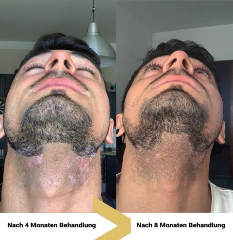 vitiligo im Gesicht