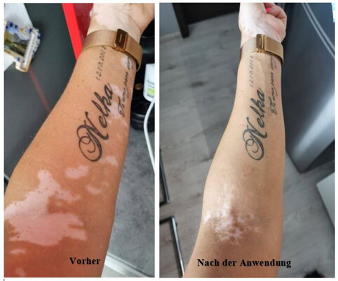 vitiligo stress