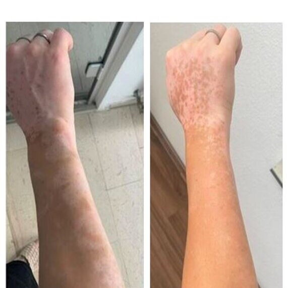 Vitiligo Repigmentierung