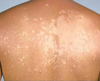 Nicht jeder einzelne weiße Fleck ist VITILIGO | Vitiligoshop.at
