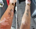Vitiligo-Starterset, 200 ml Gel + 60 Tabletten + Zanderm-Concealer