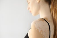 Vitiligo - Pigmentverlust