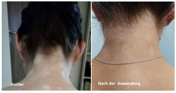 Vitiligo im Nacken