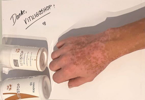 Vitiligo an den Fingern