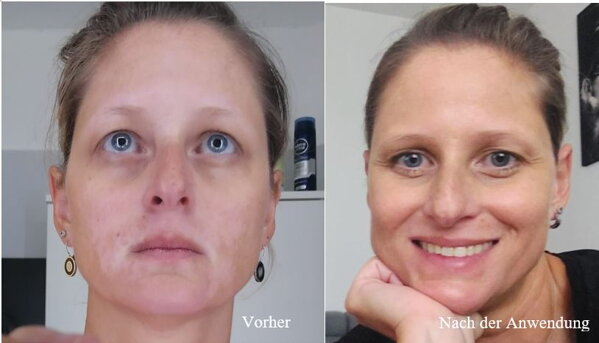 Vitiligo im Gesicht vorher und nachher