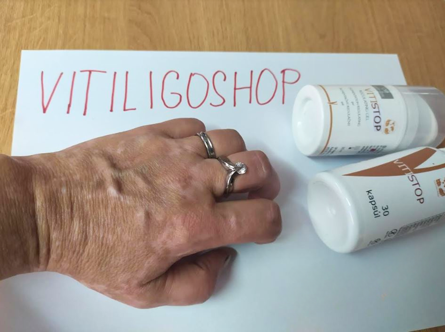 Vitiligo an der Hand – Janina V., Kundin von VitiligoShop