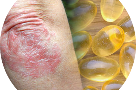 Strava a vitamíny pri psoriáze